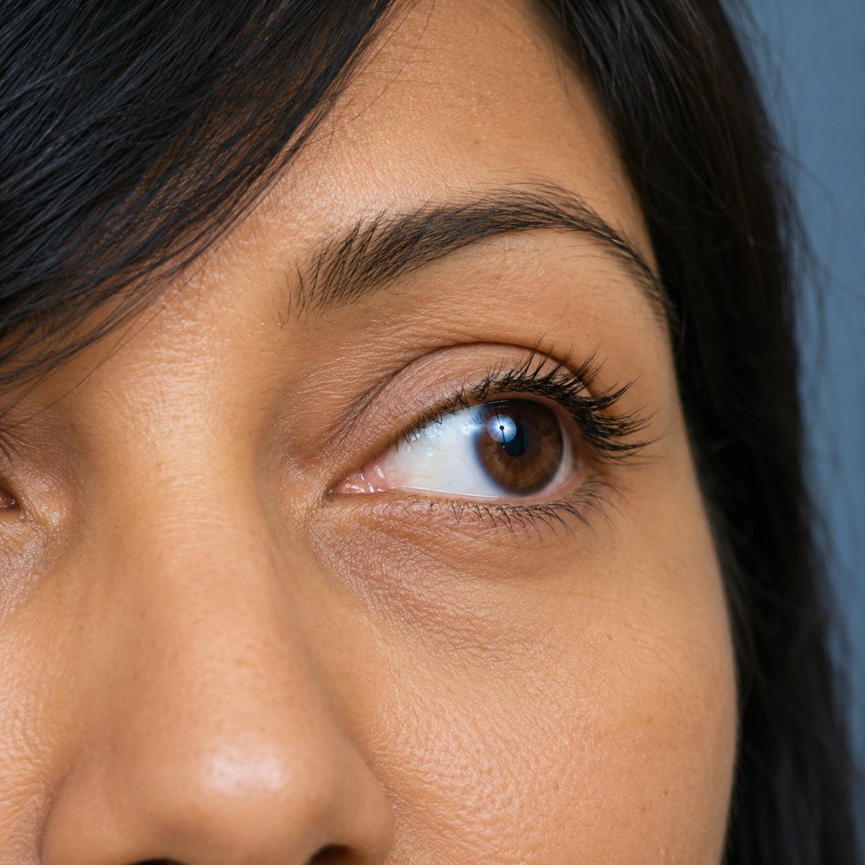 Upper Eyelid Blepharoplasty After