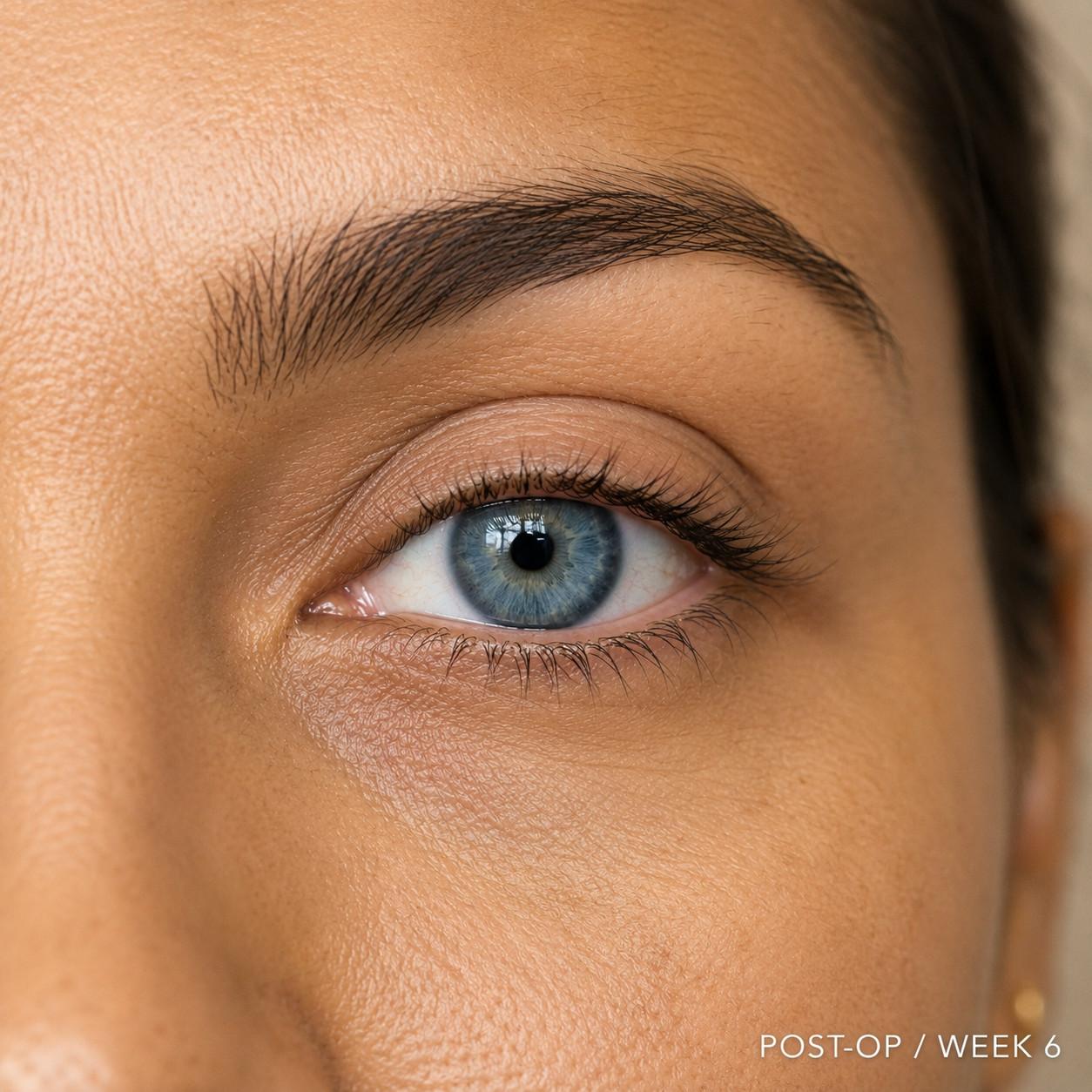 Brow Lift After